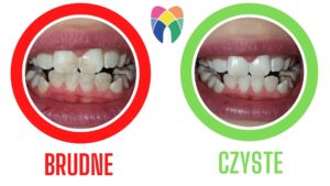 Porównanie brudnych i czystych zębów