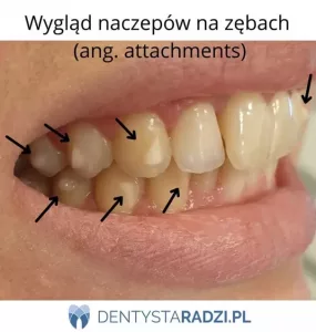 Zęby z naczepami (tzw. attachments) z białego materiału stomatologicznego umieszczonymi na zębach w celu bardziej precyzyjnych ruchów zębów podczas leczenia nakładkami prostującymi na zęby.