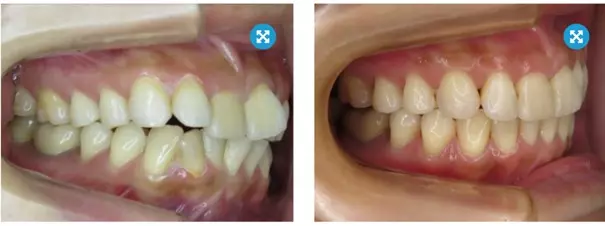 Stłoczenia zębów przed i proste zęby po leczeniu Invisalign