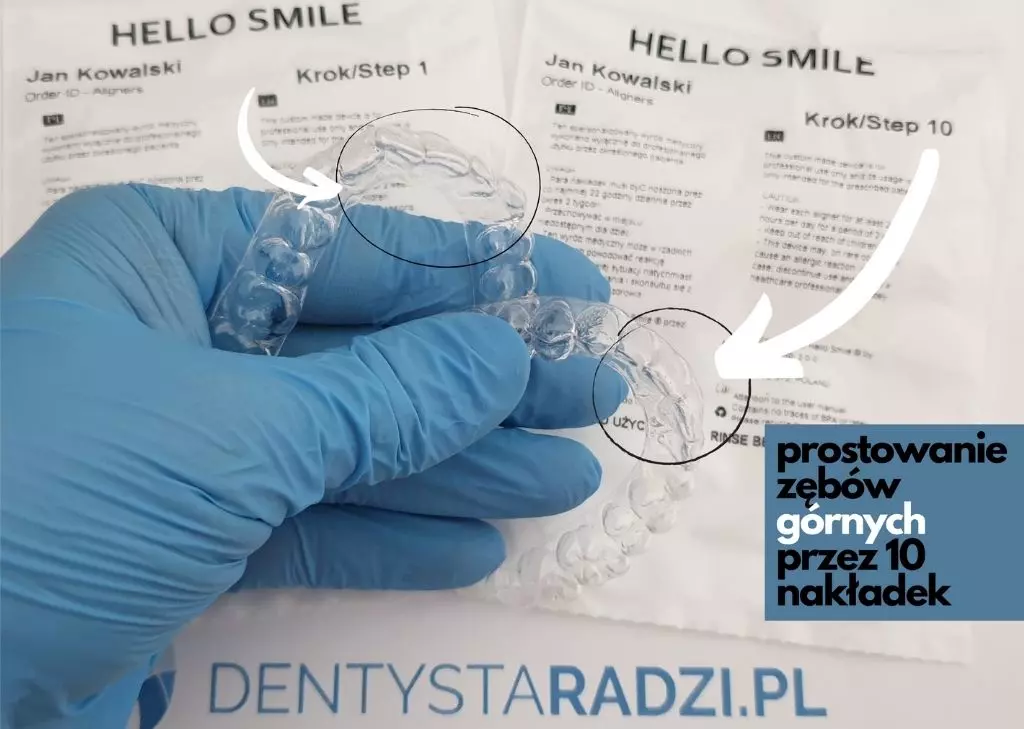 Nakładki ortodontyczne Hello Smile w kształcie zębów górnych przed i po leczeniu, trzymane w ręku w niebieskiej rękawiczce.