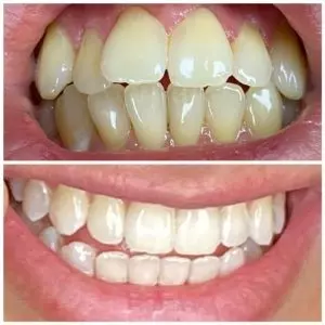 Widok wady zgryzu przed i po leczeniu ortodontycznym nakładkami Hello Smile