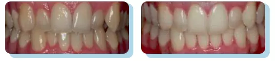 Wada zębów, zdjęcie przed leczeniem i po leczeniu ortodontycznym nakładkami Hello Smile.