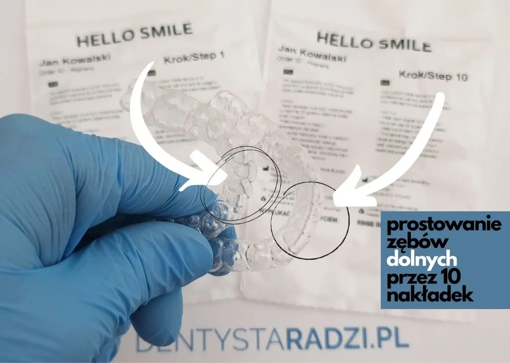 Ręka w niebieskiej rękawiczce trzyma dwie nakładki Hello Smile w kształcie przed i po prostowaniu zębów w żuchwie.