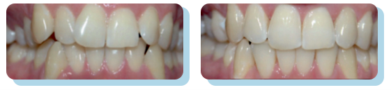 Wada zębów, stłoczenia zębów na zdjęciu przed leczeniem i po leczeniu ortodontycznym nakładkami Hello Smile.