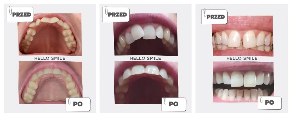 3 efekty-przed i po leczeniu-zebow nakładkami-ortodontycznymi Hello-Smile