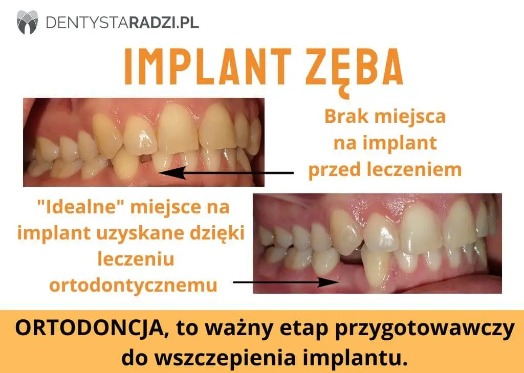 przed i po ustawieniu ortodontycznym zebow zeby miec miejsce na implant