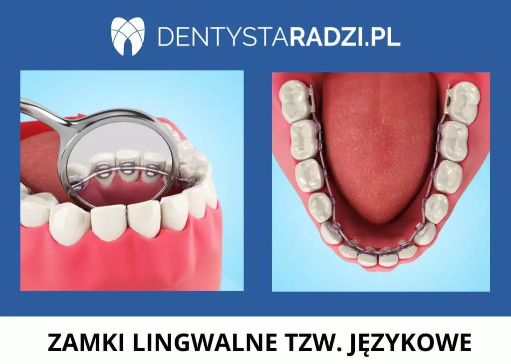 Niewidoczne zamki lingwialne czylu jezykowe naklejone na zębach od wewnetrznej strony