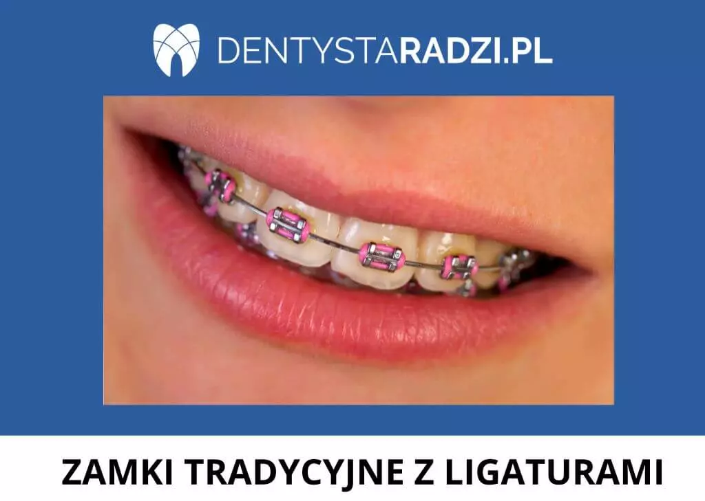 Uśmiech z różowymi ligaturkami na zamkach ortodontycznych na zębach