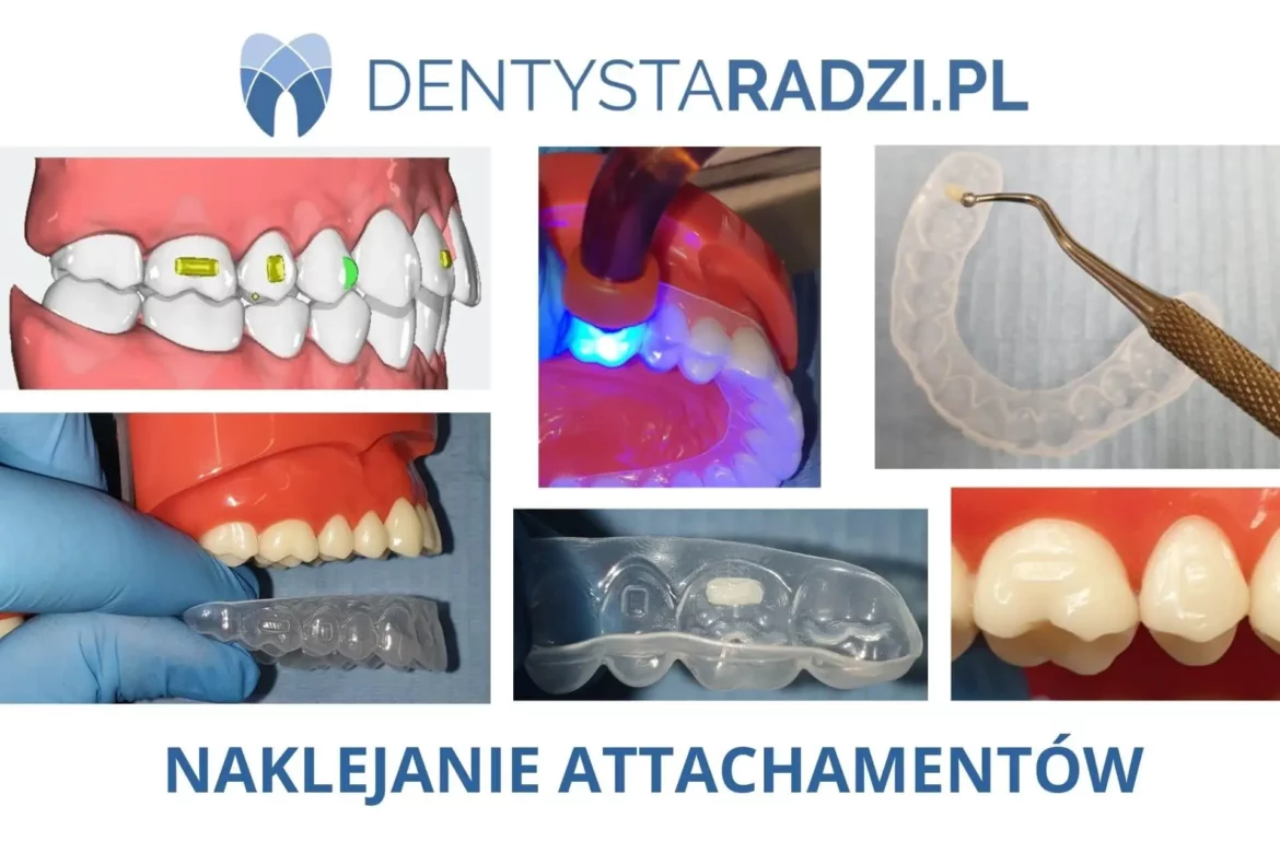 etapy naklejania naczepow attachamentow na zeby przez dentyste
