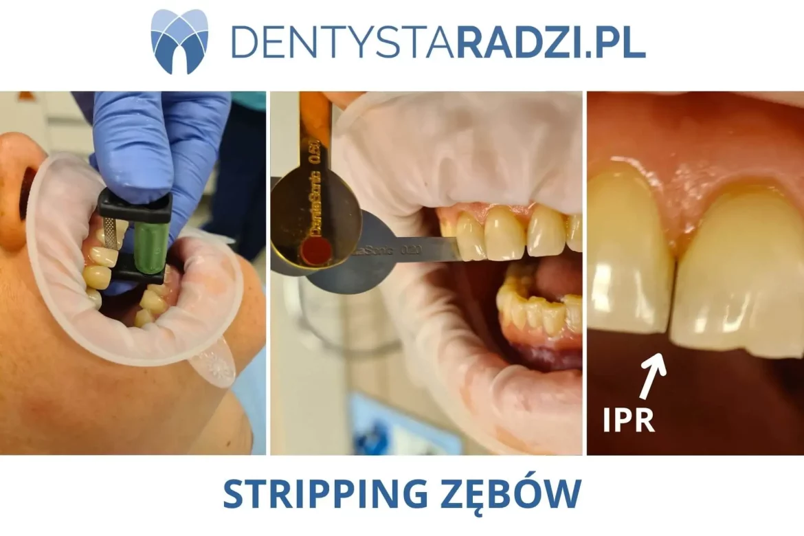 Stripping zebow etapy przed i po redukcji szliwa podczas leczenia ortodontycznego