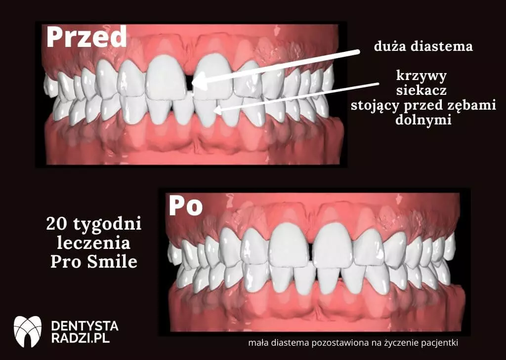 Przed i po leczeniu ułożenie zębów z diastemą 