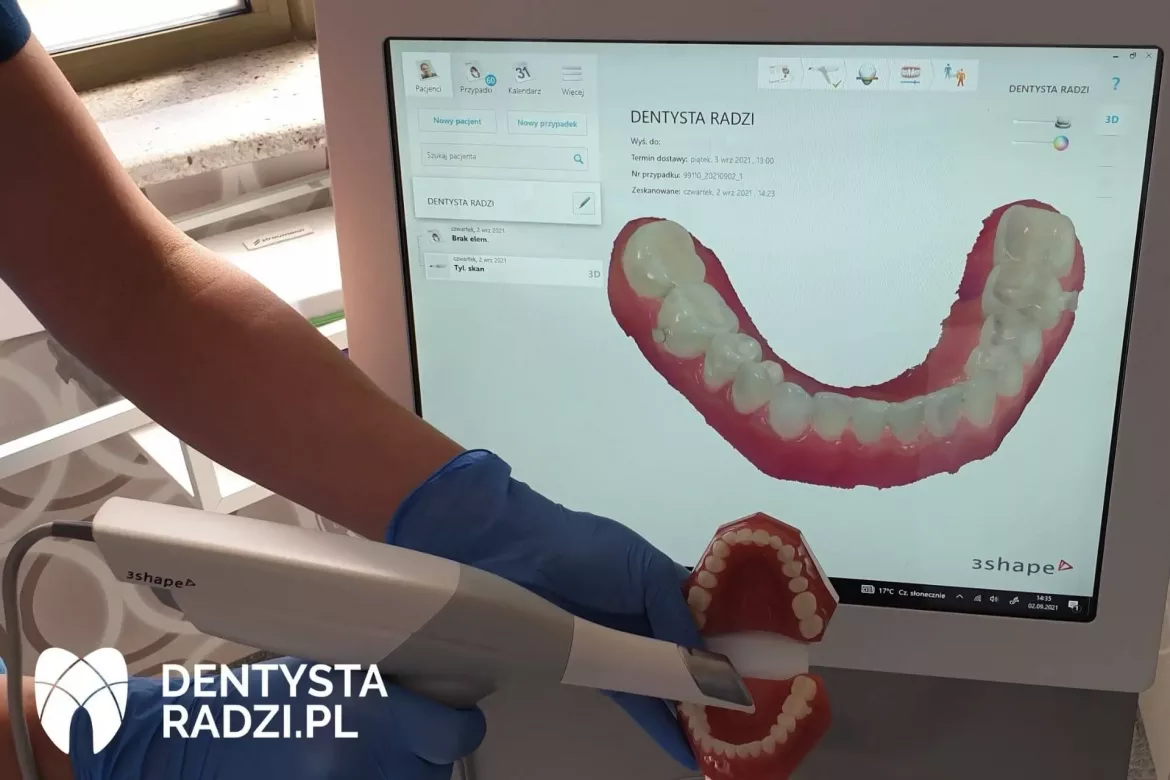 skaner stomatologiczny wewnątrzustny 3Shape białe urzędzeniew ręku dentysty na monitorze widać skan zębów 3D