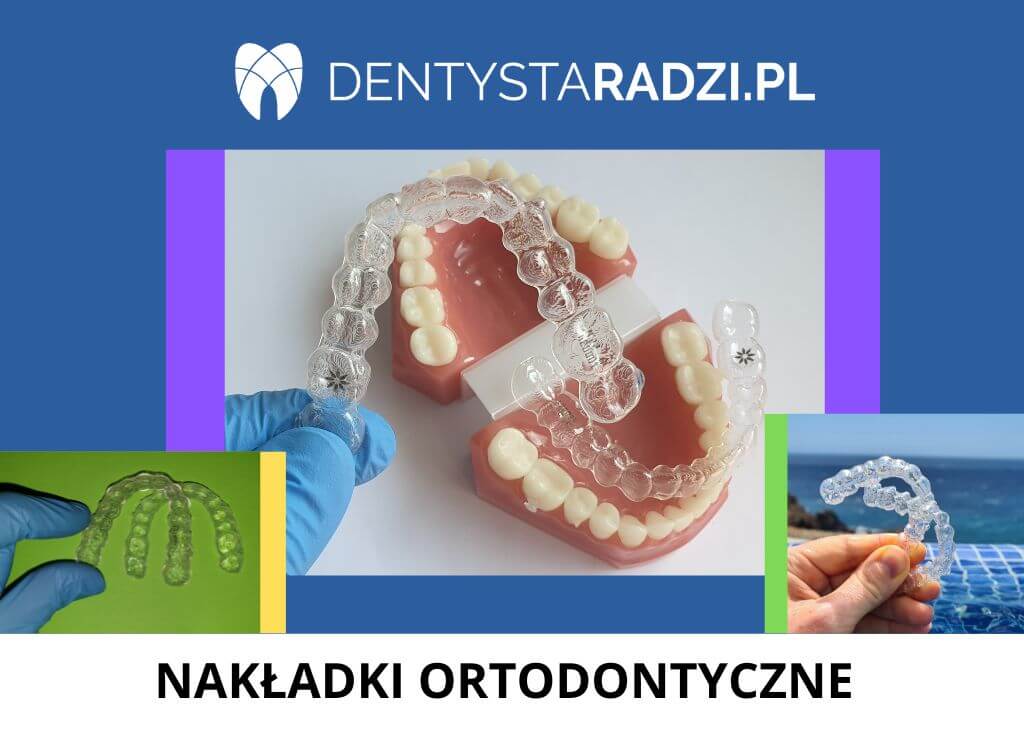 przezroczyste nakladki ortodontyczne prostujace na zeby trzy przyklady wygladu