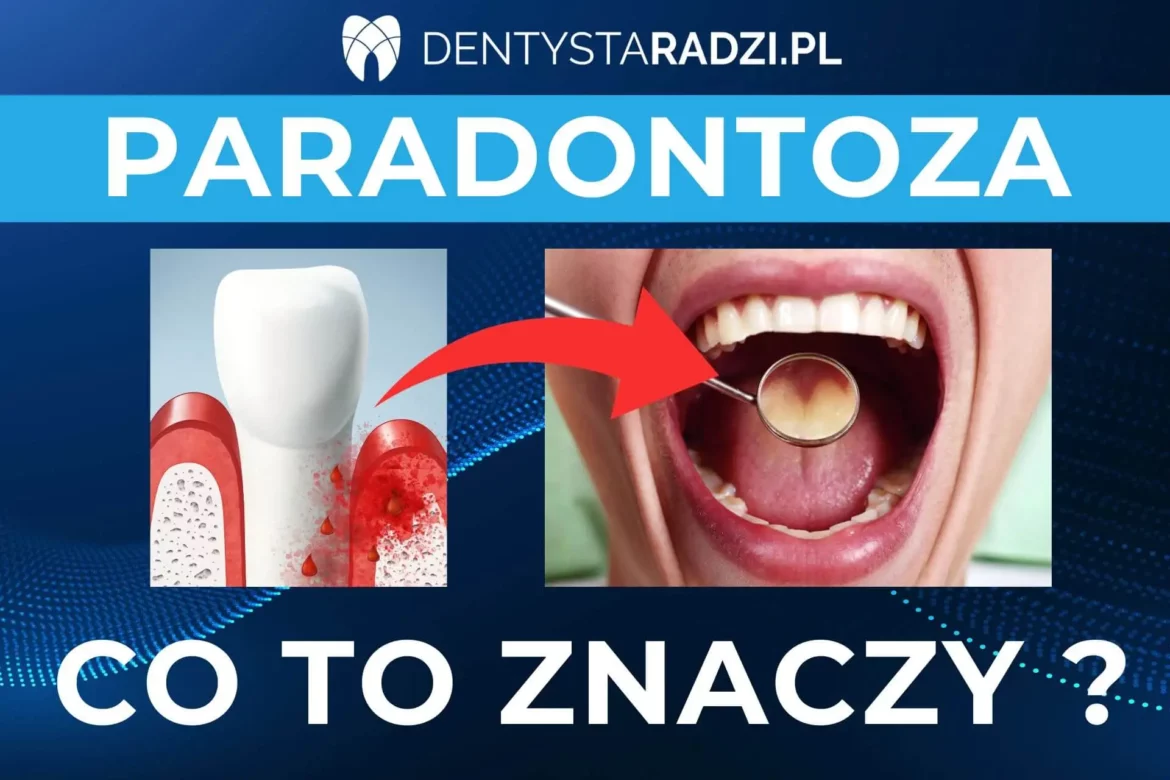 paradontoza co to znaczy zdjecie zeba z krwawiacym dziaslem i obnizona koscia i buzia z zebami pacjenta u dentysty
